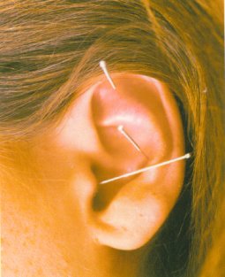 Acupunture