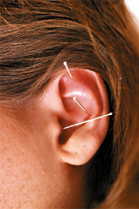 Acupuncture in the ear