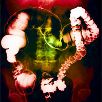 Colon cancer