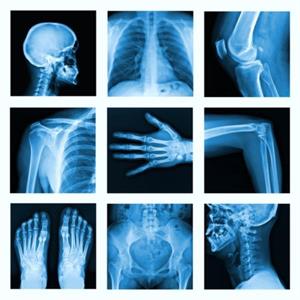 Ewings Sarcoma