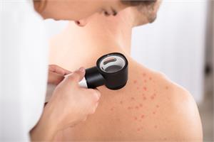 Traditional Skin Cancer Treatment, Euphorbia peplus