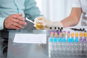 Prostate Urine test to render Biopsies obsolete