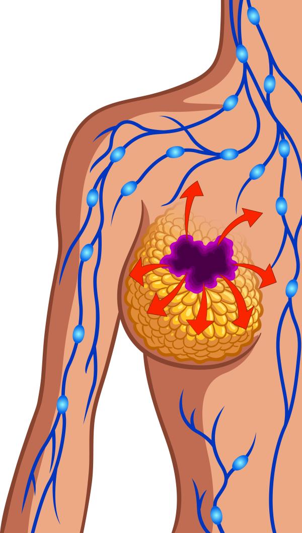 Bacteria may well play a role in breast cancer