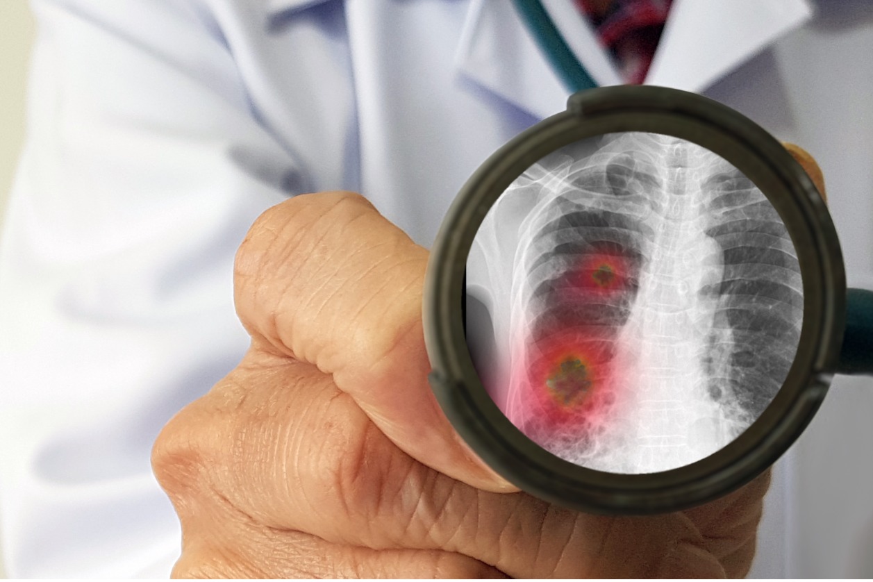 PARP Inhibitors Increase the risk of pneumonitis