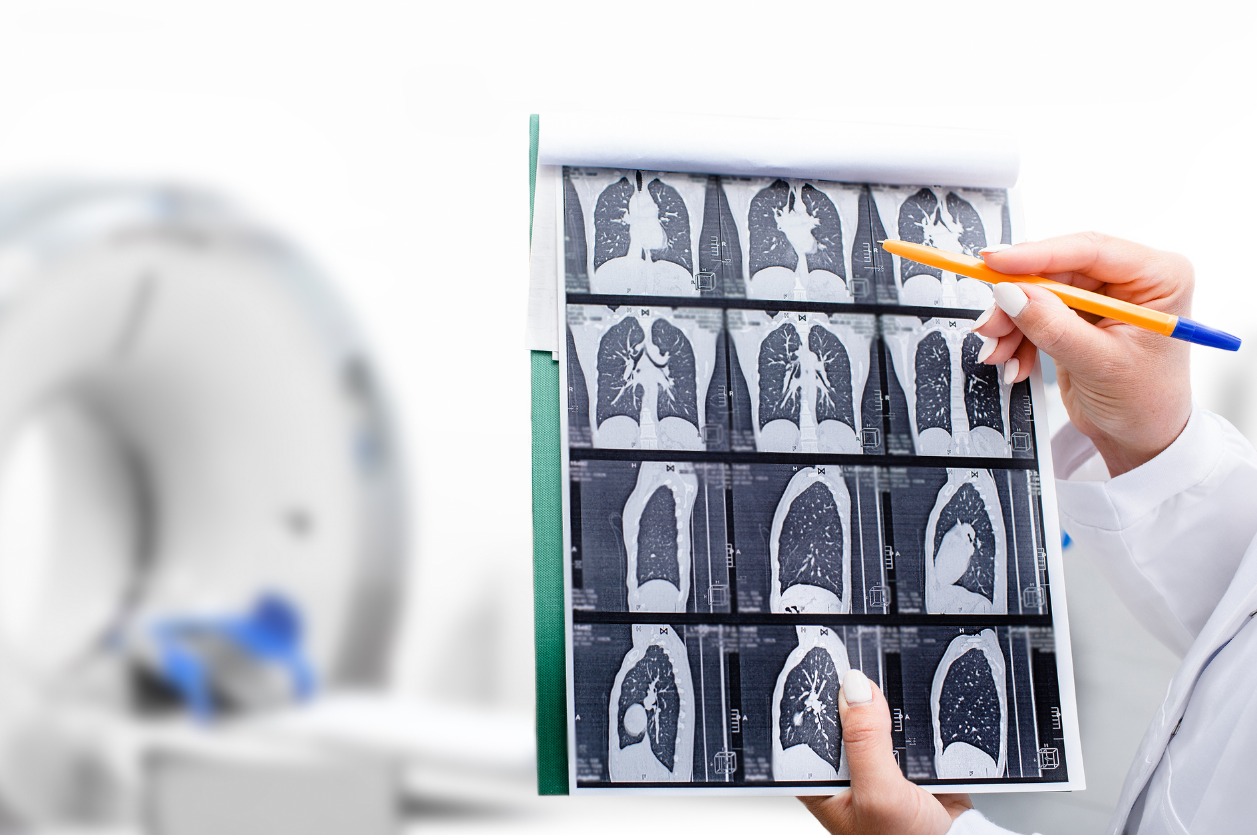 Transarterial chemoperfusion give some hope to mesothelioma patients