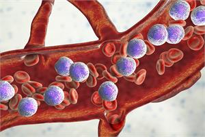 Leukaemia - Acute Lymphoblastic