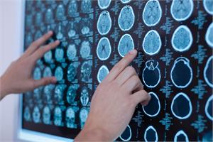 Using Clomipramine to treat brain tumours