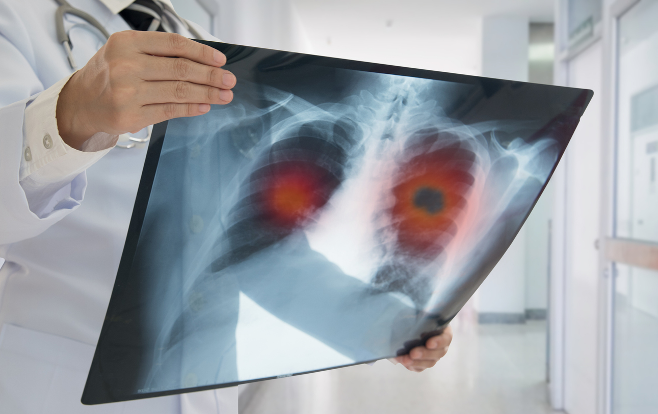 Alternative Lung Cancer Treatments