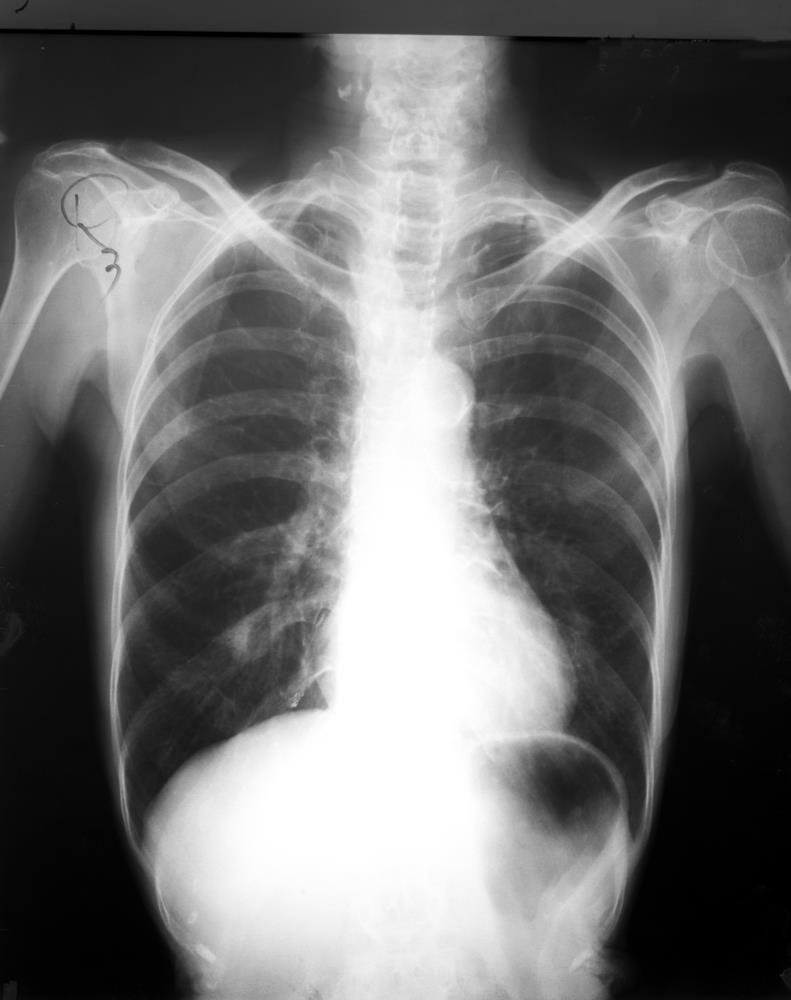 lung cancer chest x ray pictures