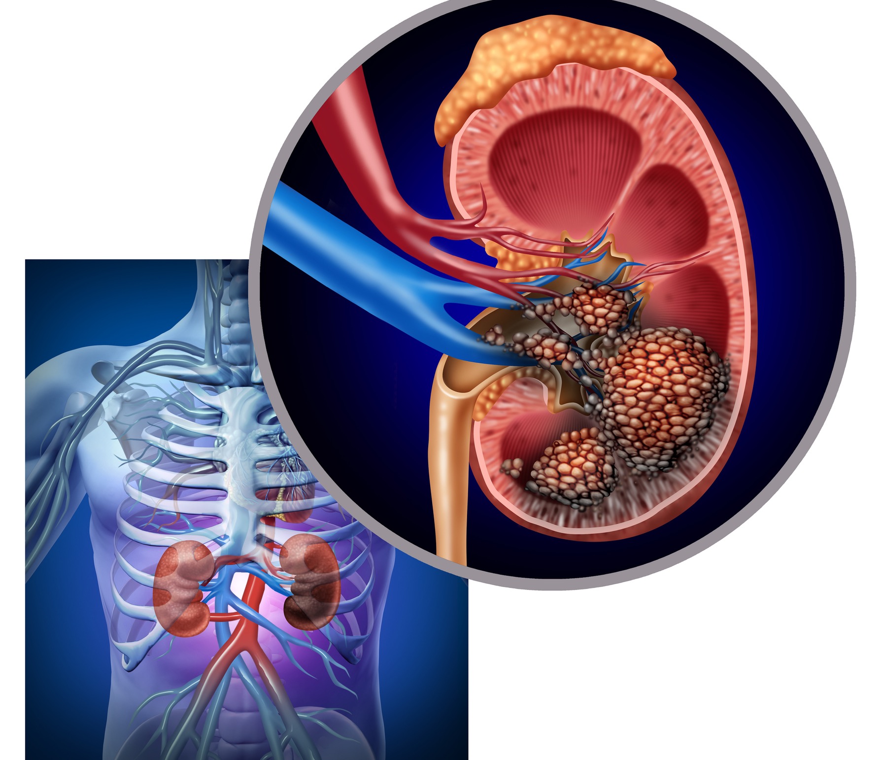 an-overview-of-kidney-cancer-symptoms-causes-and-treatment